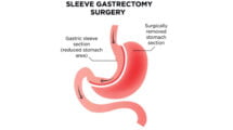 Gastric Sleeve Surgery